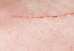 Larocheposay ArticlePage Damaged How to optimise scar healing
