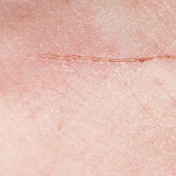 Artículo sobre el acné: imagen principal