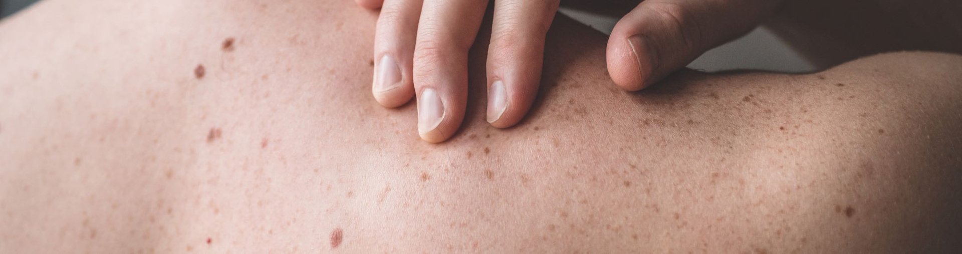 radioterapia para el cancer de piel