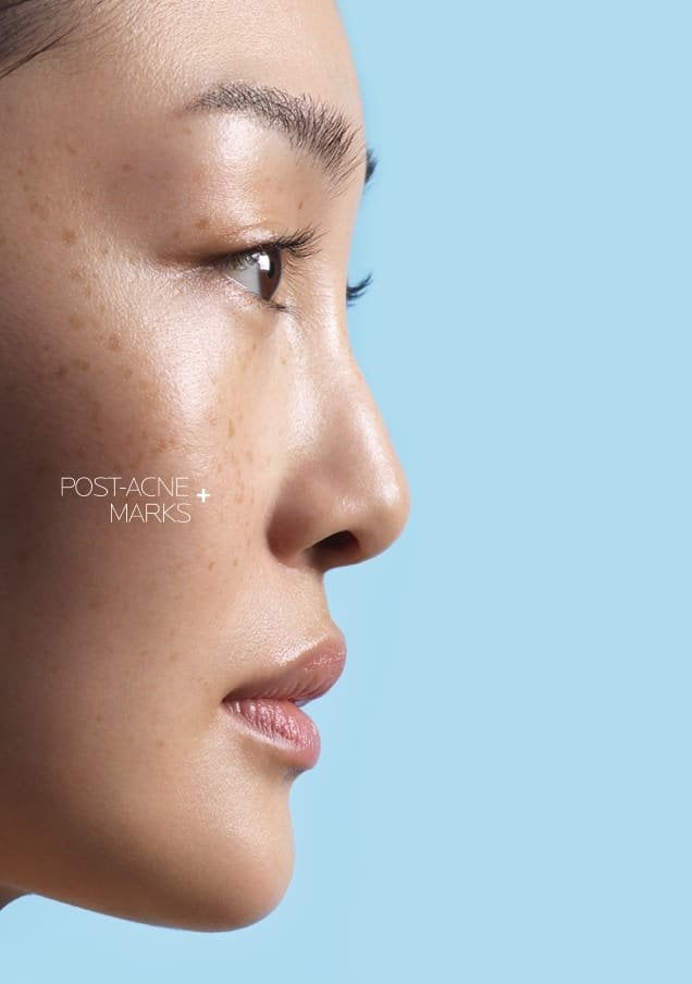 /-/media/project/loreal/brand-sites/lrp/america/latam/products/effaclar/effaclar-a-z-gel-cream/desktop/lrp-effaclar_azcream_flip_card_front_desktop_3.jpg