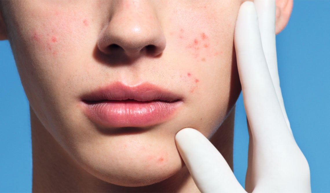 Larocheposay SubCategoryPage Acne What causes oily acne prone skin how